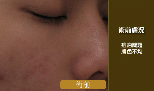 淨膚雷射-淨膚雷射效果-淨膚雷射痘疤治療前後比對-縮毛孔-毛孔粗大-美白雷射-中壢淨膚雷射-桃園淨膚雷射推薦