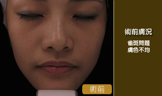 淨膚雷射-雷射除斑-桃園淨膚雷射推薦-中壢淨膚雷射-除斑-縮毛孔-淨膚雷射推薦-桃園淨膚雷射推薦-淨膚雷射效果-淨膚雷射恢復期