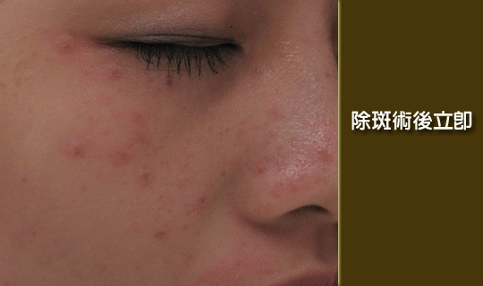 淨膚雷射-淨膚雷射除斑治療過程-淨膚雷射去除黑斑效果-中壢淨膚雷射-雷射除斑效果-淨膚雷射推薦-中永和淨膚雷射推薦-淨膚雷射效果-淨膚雷射恢復期