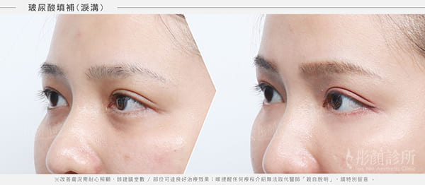 黑眼圈-黑眼圈消除-黑眼圈醫美治療-黑眼圈改善效果-玻尿酸淚溝-淚溝黑眼圈治療前後對比效果