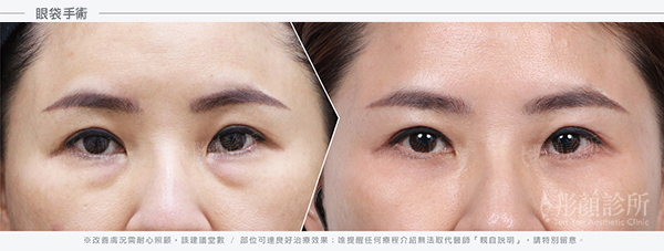 黑眼圈-眼袋手術-黑眼圈醫美治療-5d亮睛術-眼袋-淚溝-黑眼圈治療前後對比效果