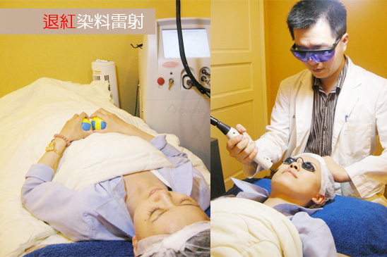 染料雷射-紅痘疤-酒糟肌膚