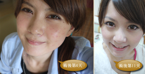 染料雷射-紅痘疤-酒糟肌膚-染料雷射效果-染料雷射治療紅痘疤