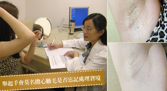 雷射除毛-腋下除毛前後效果比對-中壢除毛-除腋毛-除毛雷射推薦-桃園除毛-林口雷射除毛