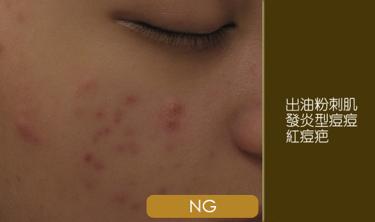 AB酸-粉刺-毛孔-痘痘-出油-皮膚專科-皮膚管理專家-換膚價格-長痘痘怎麼辦-果酸換膚-抗痘