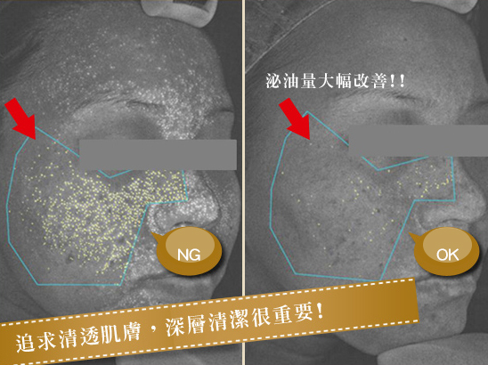 AB酸換膚-粉刺-毛孔-痘痘-出油-皮膚專科-皮膚管理專家-長痘痘怎麼辦-果酸換膚費用