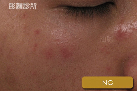 AB酸-粉刺-毛孔-痘痘-出油-皮膚專科-皮膚管理專家-長痘痘怎麼辦-果酸換膚費用