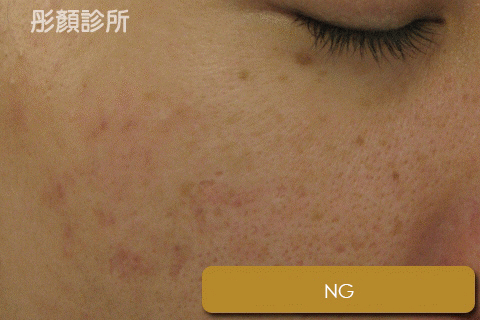 AB酸-粉刺-毛孔-痘痘-出油-皮膚專科-皮膚管理專家-長痘痘怎麼辦-果酸換膚價格