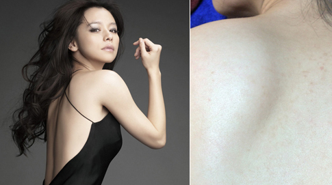 彤顏杏仁酸-杏仁酸換膚-杏仁酸效果-美白-痘疤-痘痘-杏仁酸煥膚-清粉刺-消痘疤-中壢醫美-桃園醫美-八德醫美-美背