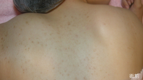 杏仁酸-杏仁酸換膚-杏仁酸效果-美白-痘疤-痘痘-杏仁酸煥膚-清粉刺-消痘疤-中壢醫美-桃園醫美-八德醫美-杏仁酸美背