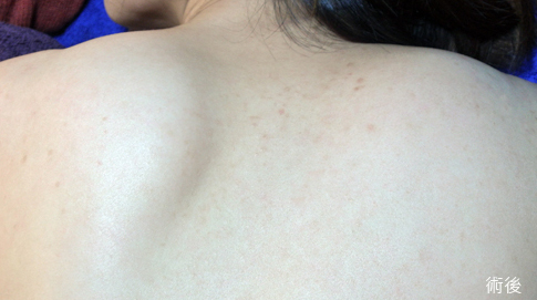 杏仁酸-杏仁酸換膚-杏仁酸美背前後效果比對-杏仁酸煥膚-杏仁酸痘疤-中壢醫美杏仁酸推薦-桃園醫美-八德醫美-杏仁酸濃度