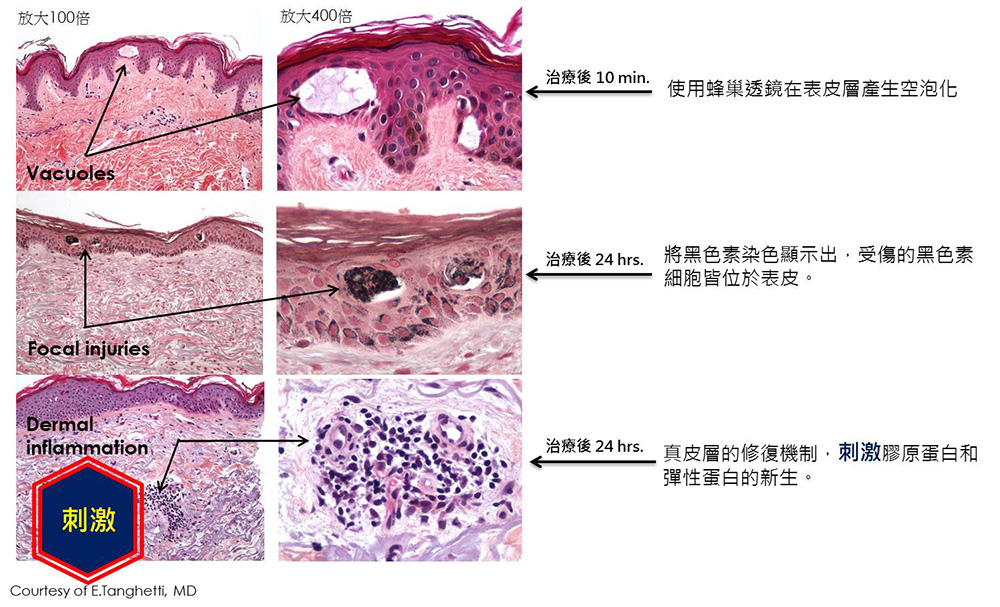 彤顏診所-推薦皮秒雷射-蜂巢皮秒-推薦皮秒雷射除斑-皮秒雷射痘疤-林口皮秒-桃園皮秒