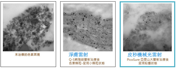 皮秒雷射-蜂巢皮秒-皮秒雷射除斑-皮秒雷射價格-林口皮秒-桃園皮秒