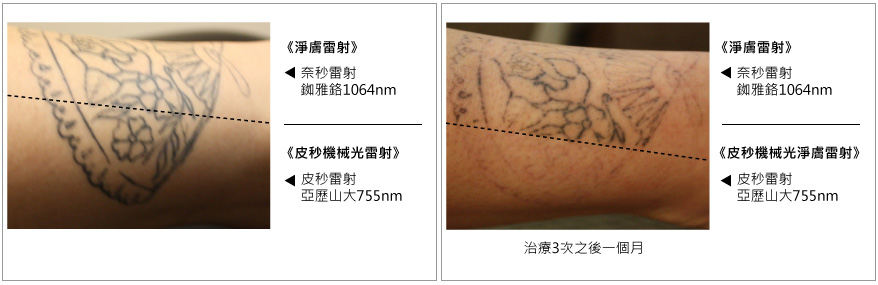 皮秒雷射-皮秒除刺青-皮秒雷射效果-林口皮秒-桃園皮秒