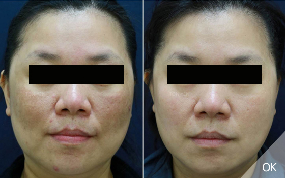 皮秒雷射除斑效果-皮秒雷射-皮秒雷射效果前後對比圖-蜂巢皮秒-皮秒雷射除斑-皮秒雷射痘疤-林口皮秒-桃園皮秒