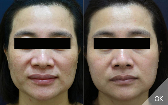 皮秒雷射除斑推薦-皮秒雷射-皮秒雷射醫美推薦-皮秒雷射除斑BA照-皮秒雷射除斑效果-林口皮秒-桃園皮秒