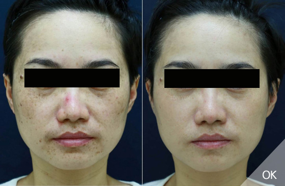 皮秒雷射推薦-皮秒雷射除斑效果-蜂巢皮秒推薦-皮秒雷射淡斑前後對比圖-林口皮秒-桃園皮秒