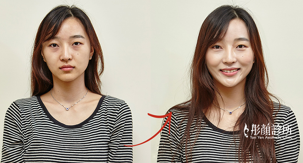 皮秒雷射-蜂巢皮秒-皮秒雷射前後對比圖-除斑-除刺青-皮膚管理專家-雙皮秒