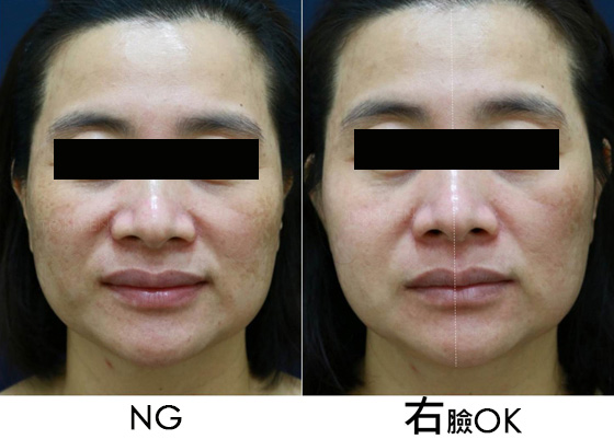 皮秒雷射-蜂巢皮秒-皮秒雷射除斑前後對比圖-皮秒雷射肝斑-755蜂巢皮秒-雙皮秒-林口皮秒-桃園皮秒