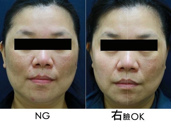 皮秒雷射-蜂巢皮秒-皮秒雷射除斑-皮秒雷射治療對比圖-755蜂巢皮秒-雙皮秒-林口皮秒-桃園皮秒