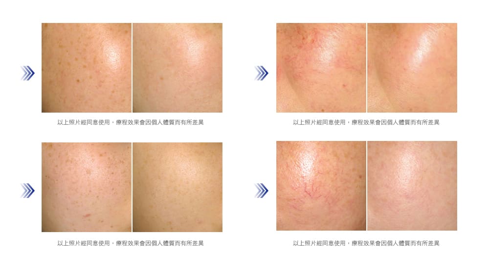 彩衝光-彩衝光治療效果前後對比-紅痘疤-酒糟肌膚-彩衝光除斑-醫美
