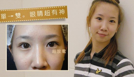 雙眼皮-訂書針雙眼皮-縫雙眼皮-眼神放大術-開眼頭-蒙古摺-雙眼皮手術推薦