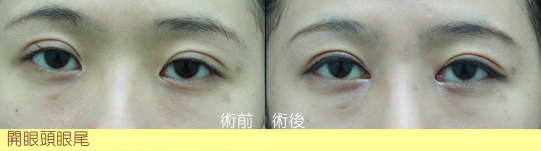 訂書針雙眼皮-割雙眼皮-雙眼皮手術