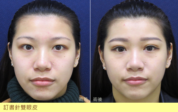 訂書針雙眼皮-割雙眼皮-開眼頭-雙眼皮手術