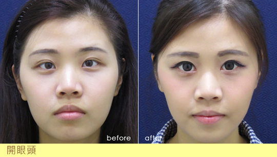 訂書針雙眼皮-割雙眼皮-開眼頭-眼神放大術-蒙古摺-雙眼皮手術
