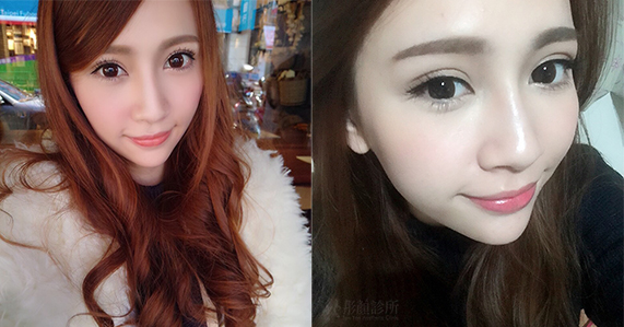 訂書針雙眼皮-彤顏-割雙眼皮-眼神放大術-開眼頭-蒙古摺-提眼瞼肌-電眼-雙眼皮手術