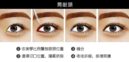 訂書針雙眼皮-割雙眼皮-開眼頭-眼神放大術-蒙古摺-雙眼皮手術