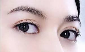 訂書針雙眼皮-割雙眼皮-開眼頭-眼神放大術-蒙古摺-雙眼皮手術