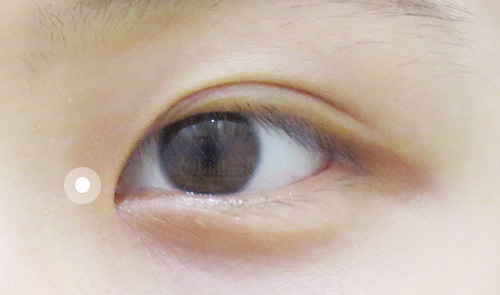 訂書針雙眼皮-割雙眼皮-開眼頭-眼神放大術-蒙古摺-雙眼皮手術