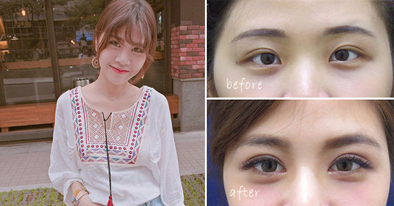 訂書針雙眼皮-割雙眼皮-開眼頭-眼神放大術-開眼頭-蒙古摺-雙眼皮手術