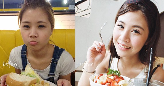 訂書針雙眼皮-割雙眼皮-開眼頭-眼神放大術-蒙古摺-雙眼皮手術