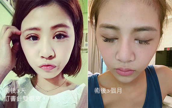 訂書針雙眼皮-割雙眼皮-開眼頭-眼神放大術-蒙古摺-雙眼皮手術