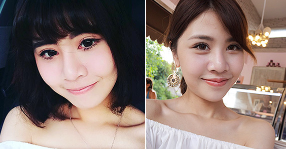 訂書針雙眼皮-割雙眼皮-開眼頭-眼神放大術-蒙古摺-雙眼皮手術