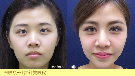 訂書針雙眼皮-割雙眼皮-開眼頭-眼神放大術-蒙古摺-雙眼皮手術