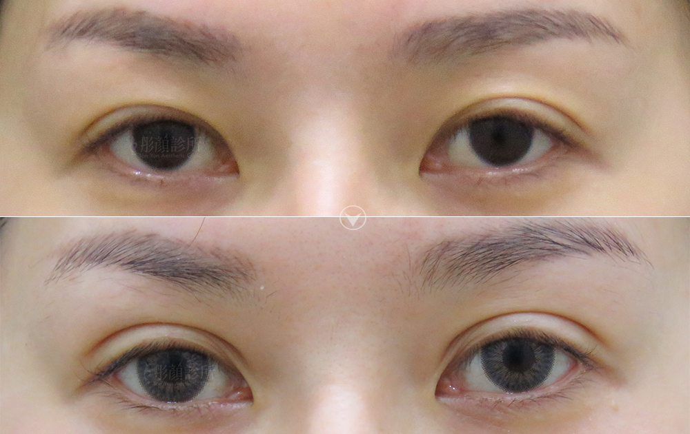 訂書針雙眼皮-彤顏-縫雙眼皮-開放式雙眼皮-封閉式雙眼皮-眼神放大術-開眼頭-蒙古摺-提眼瞼肌-雙眼皮手術效果前後對比-雙眼皮手術