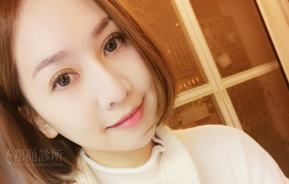 訂書針雙眼皮-彤顏-縫雙眼皮-開放式雙眼皮-封閉式雙眼皮-眼神放大術-開眼頭-蒙古摺--提眼瞼肌-電眼-雙眼皮手術