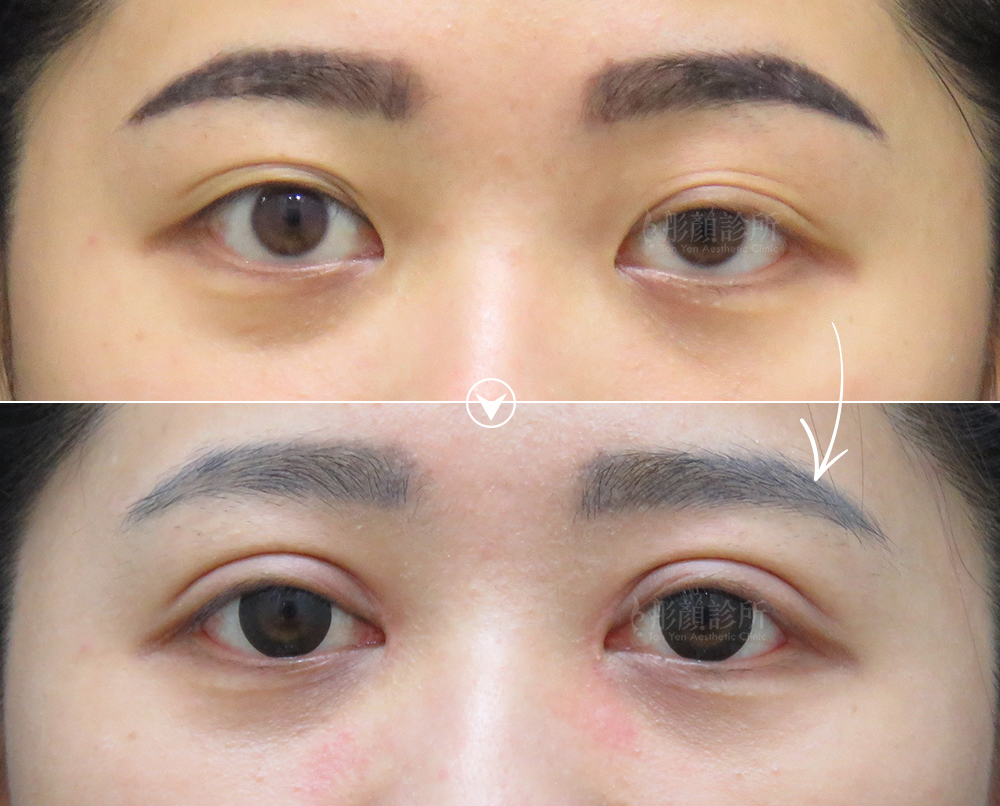 彤顏雙眼皮-提眼瞼肌手術前後效果比較-提眼瞼肌手術推薦-大小眼-割雙眼皮-雙眼皮手術
