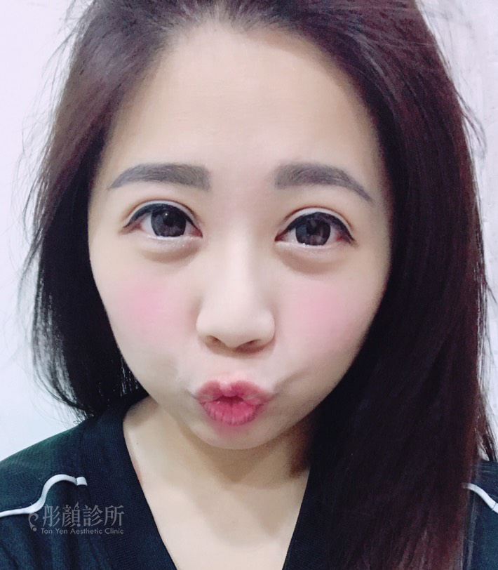 訂書針雙眼皮-彤顏-縫雙眼皮-提眼瞼肌-大小眼-割雙眼皮-取脂肪-電眼-雙眼皮手術