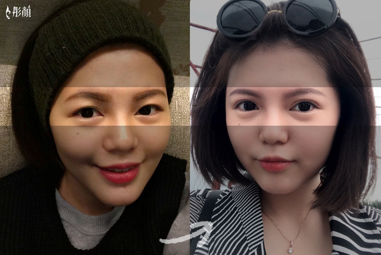 訂書針雙眼皮-彤顏-割雙眼皮-開放式雙眼皮-封閉式雙眼皮-取脂肪-修皮-泡泡眼-金魚眼-雙眼皮手術