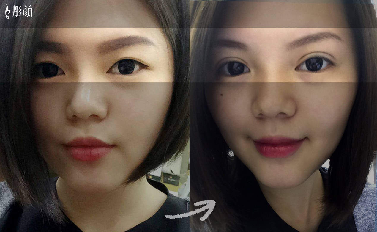 訂書針雙眼皮-彤顏-割雙眼皮-開放式雙眼皮-封閉式雙眼皮-取脂肪-修皮-泡泡眼-金魚眼-電眼-雙眼皮手術