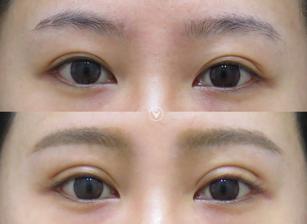 雙眼皮-訂書針雙眼皮-彤顏-縫雙眼皮-開放式雙眼皮-封閉式雙眼皮-眼神放大術-開眼頭-蒙古摺-提眼瞼肌-電眼-雙眼皮手術-劉宏貞醫師