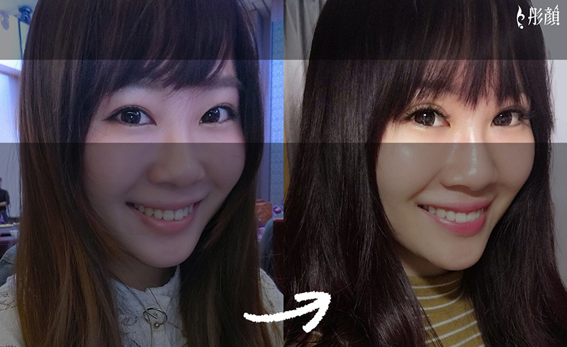 訂書針雙眼皮-雙眼皮-縫雙眼皮-開放式雙眼皮-封閉式雙眼皮-眼神放大術-雙眼皮手術前後對比-雙眼皮手術-劉宏貞醫師