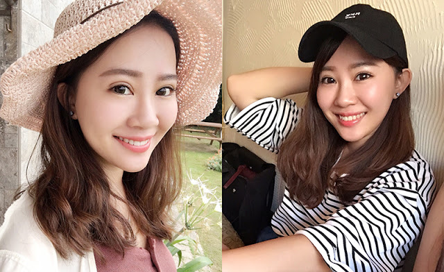 訂書針雙眼皮-彤顏雙眼皮-開放式雙眼皮-雙眼皮手術前後效果比較-雙眼皮手術