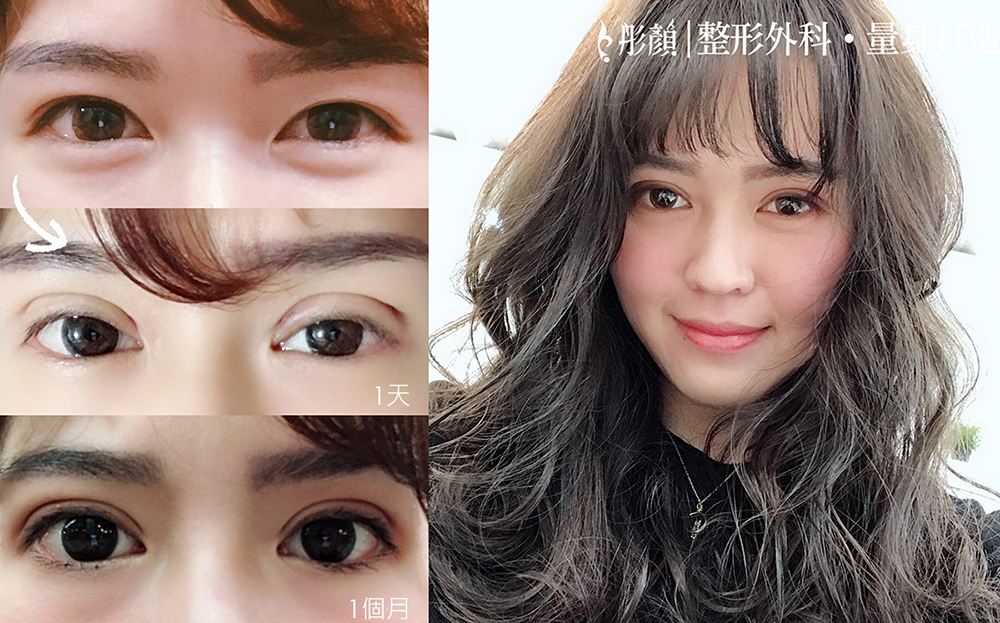 訂書針雙眼皮-彤顏-縫雙眼皮-訂書針雙眼皮手術前後效果比較-開放式雙眼皮-電眼-雙眼皮手術-劉宏貞醫師