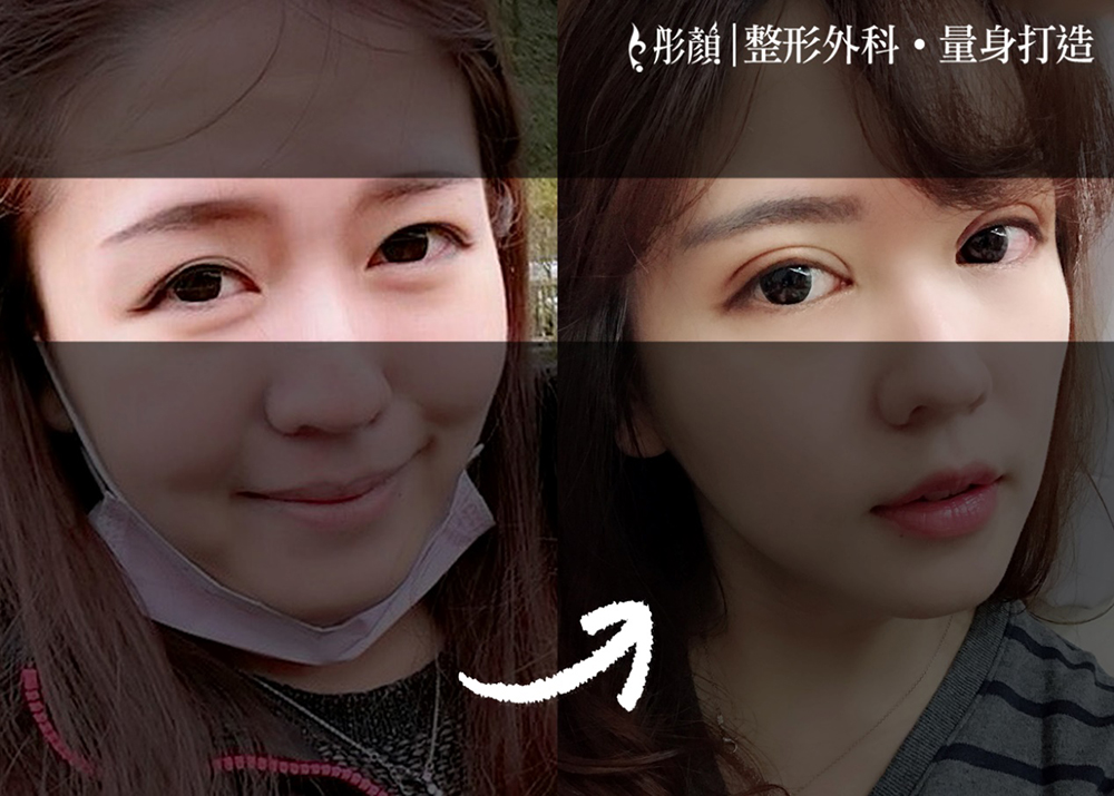 雙眼皮-訂書針雙眼皮-彤顏-縫雙眼皮-開放式雙眼皮-雙眼皮手術推薦-劉宏貞醫師