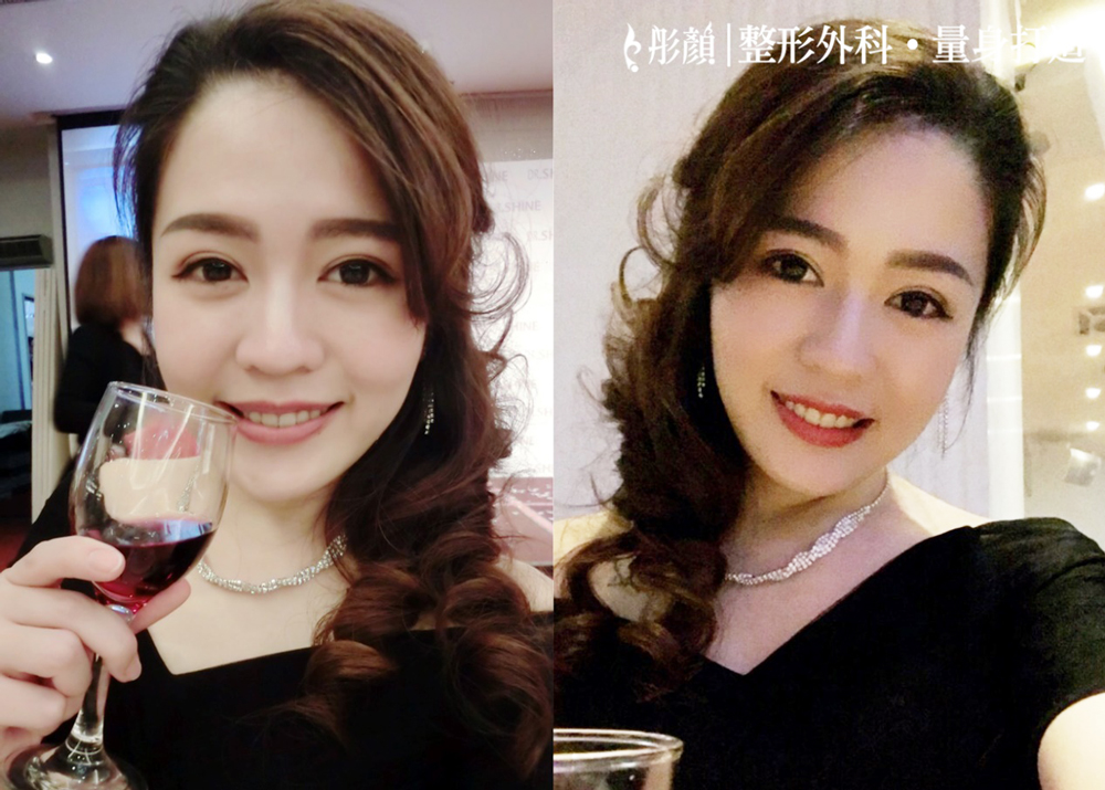 訂書針雙眼皮-縫雙眼皮-雙眼皮推薦-開放式雙眼皮-電眼-雙眼皮手術-劉宏貞醫師